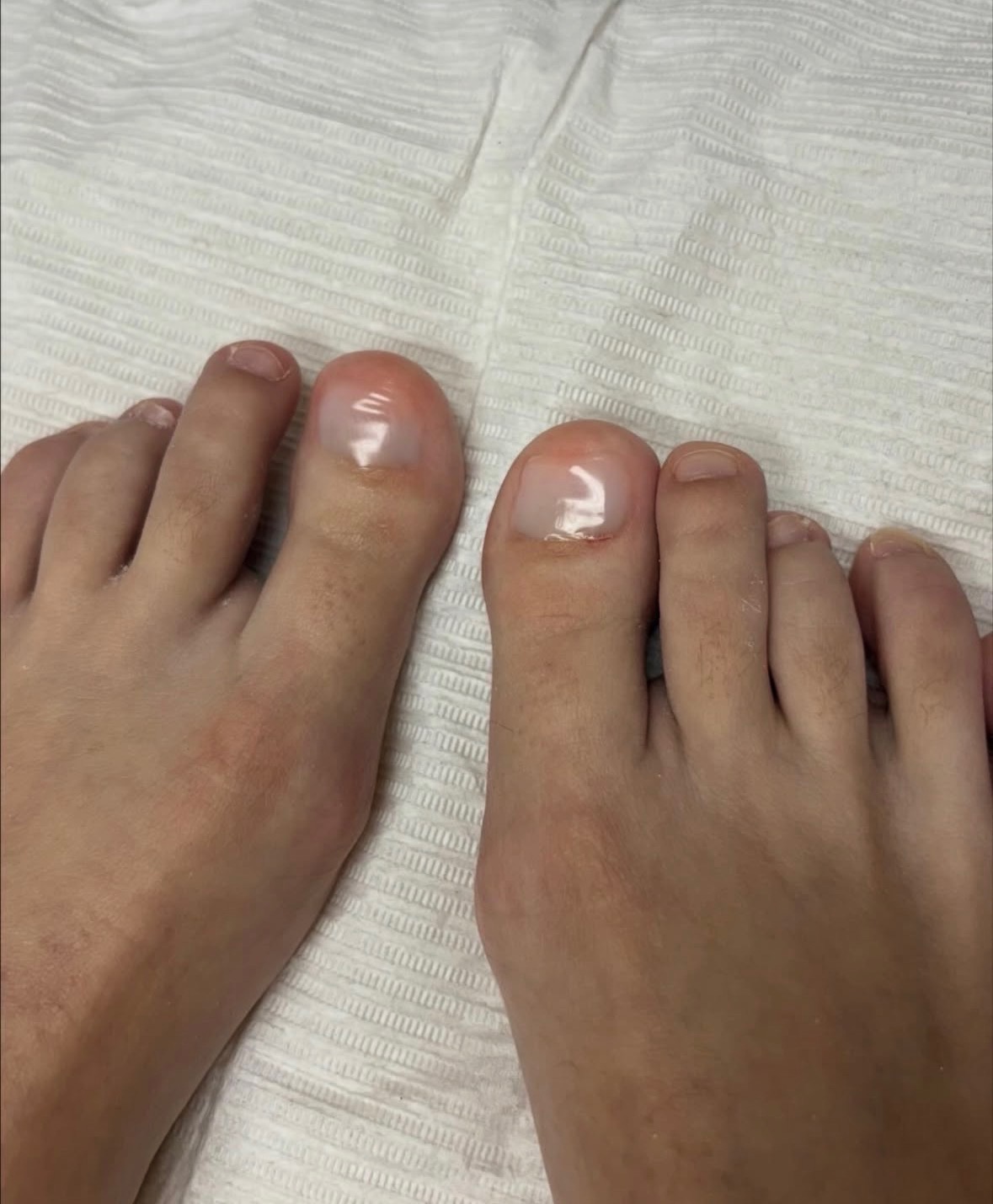 The same two toenails with smooth, evenly shaped, natural-looking nail surfaces after KeryFlex Nail Restoration.