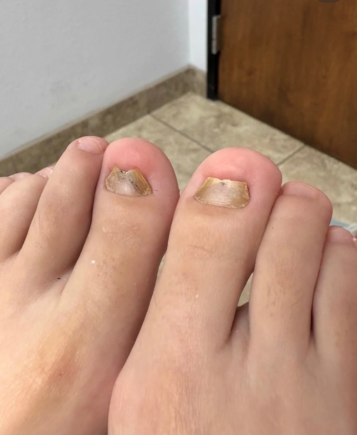 Two toenails with thickened, discolored, and irregular nail plates before KeryFlex Nail Restoration.