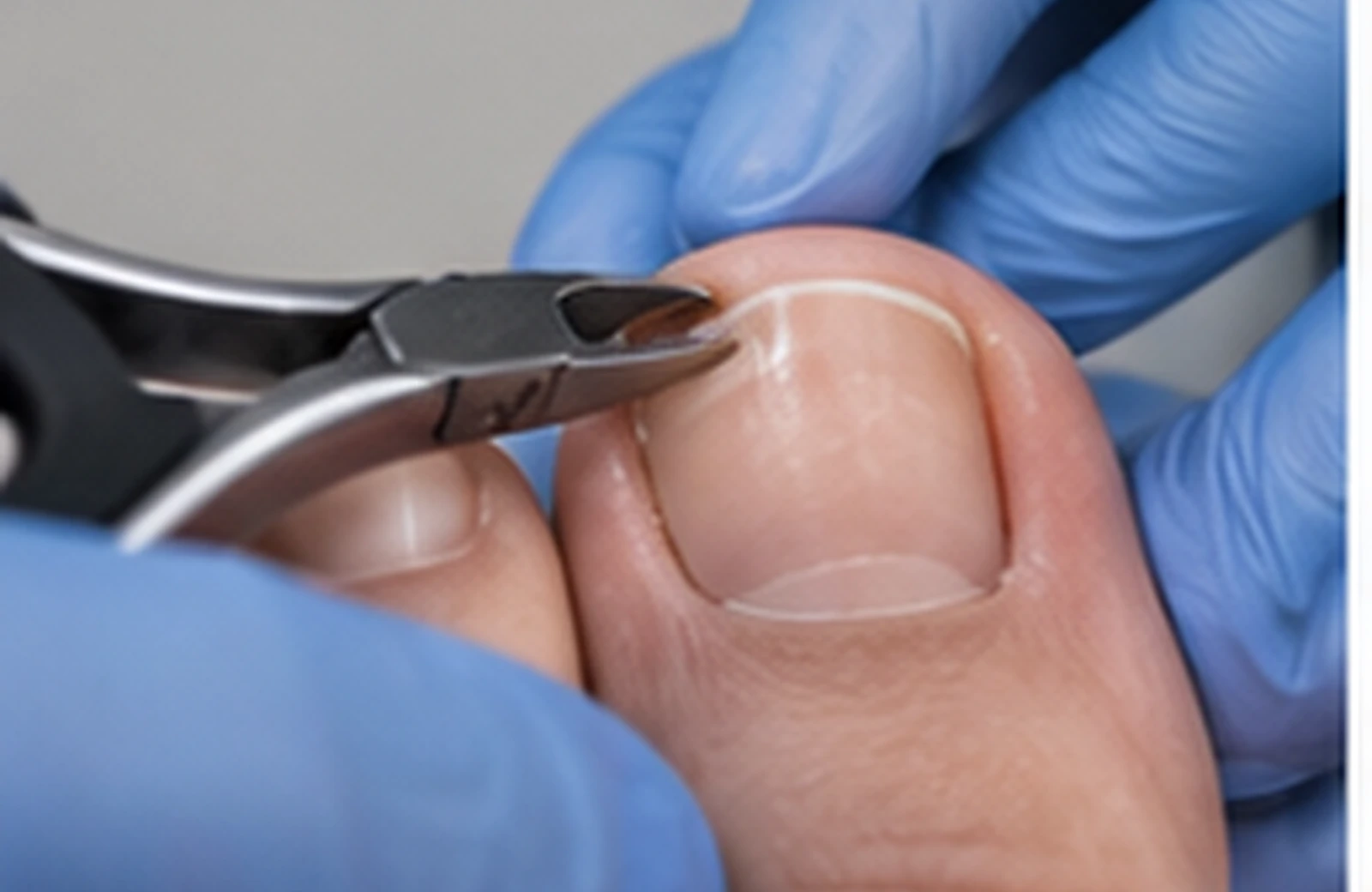 Gloved hands using a sterile nail instrument at the border of a big-toe nail.