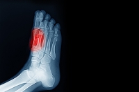 Sesamoiditis Facts