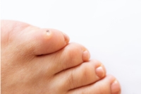 Corns and Calluses Can Cause Discomfort in the Feet